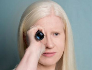 ocular albinism blue eyes